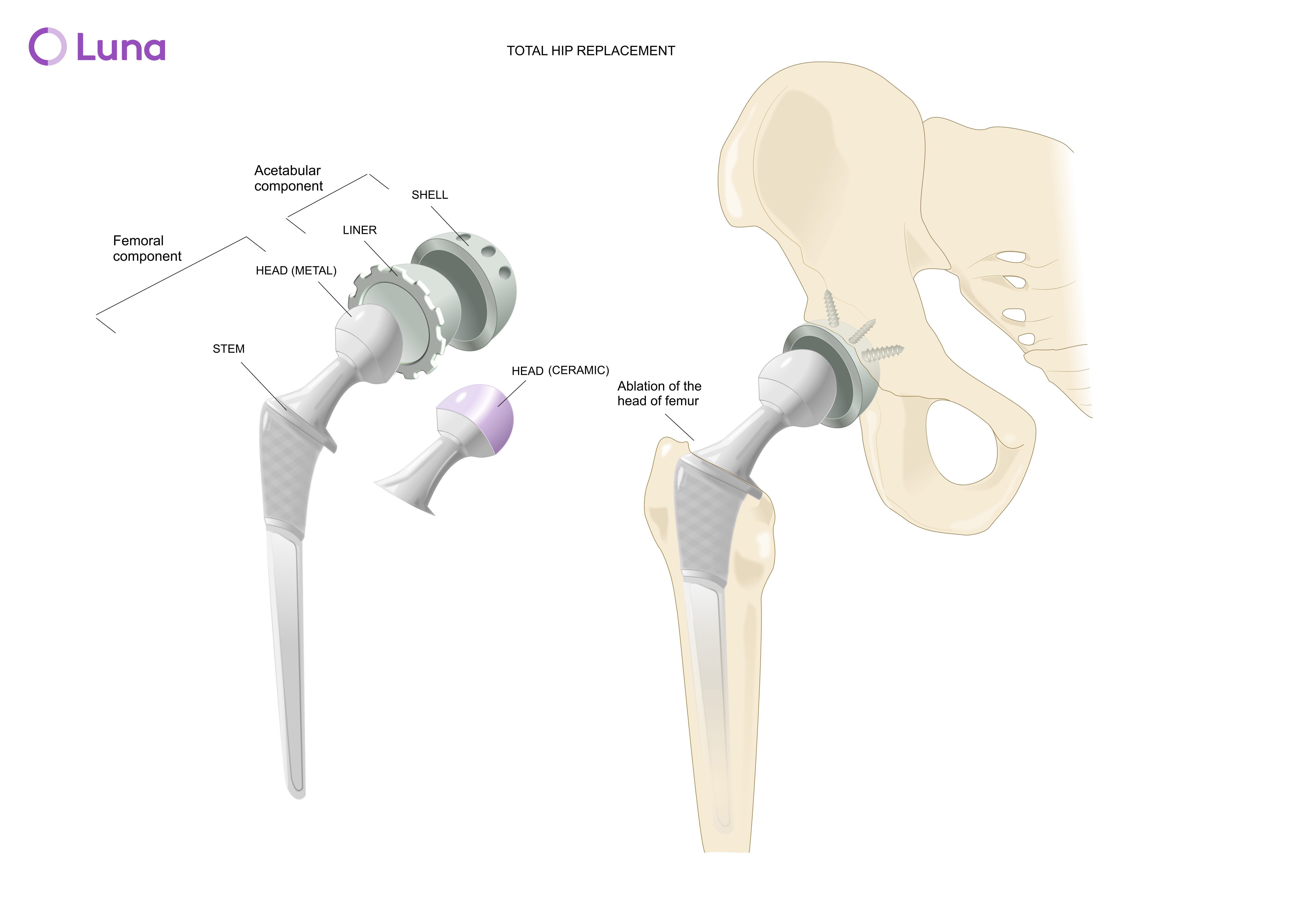 Anterior Hip Replacement - Orthopedic Specialists of Seattle