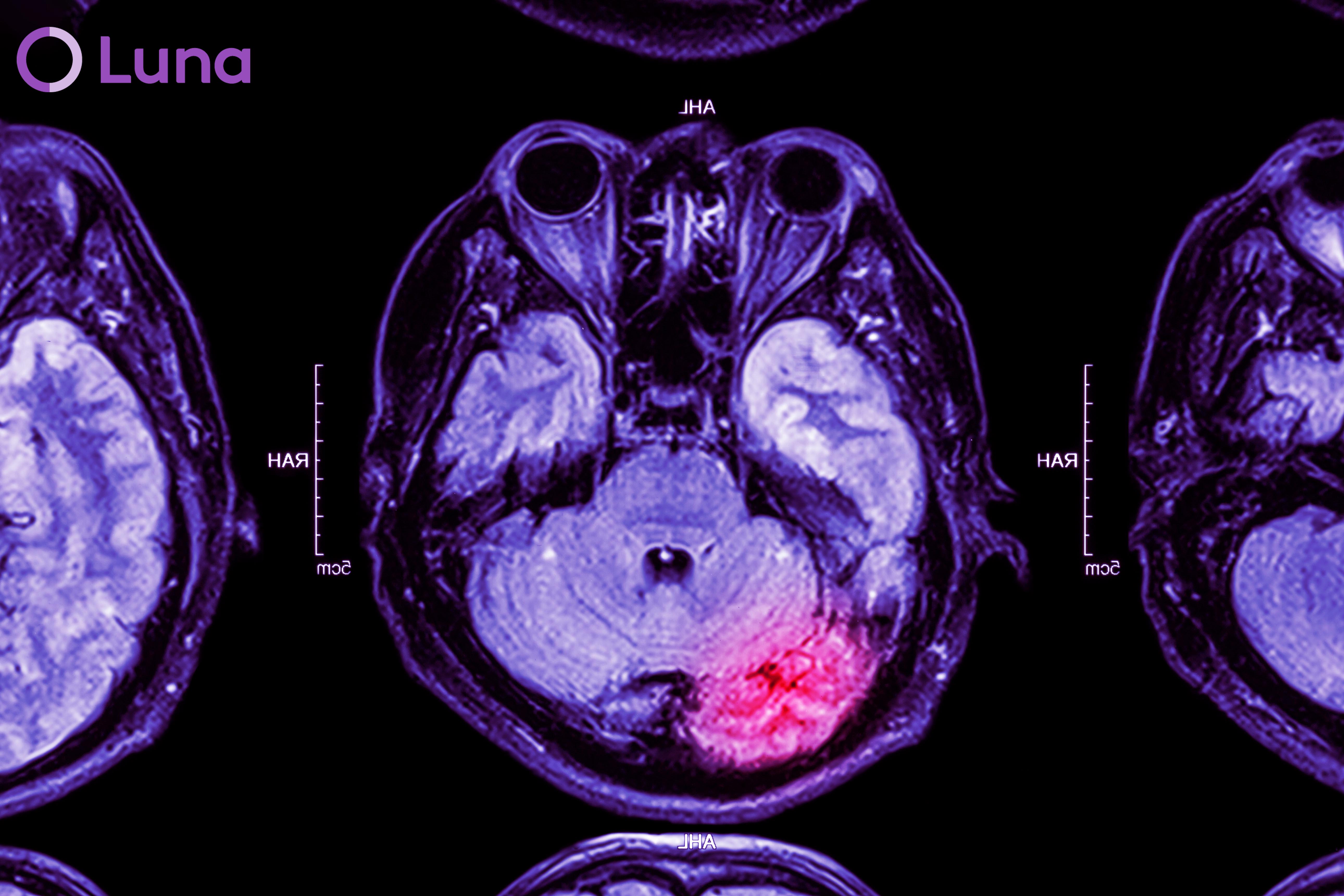 On-Demand Physical Therapy for Stroke Patients