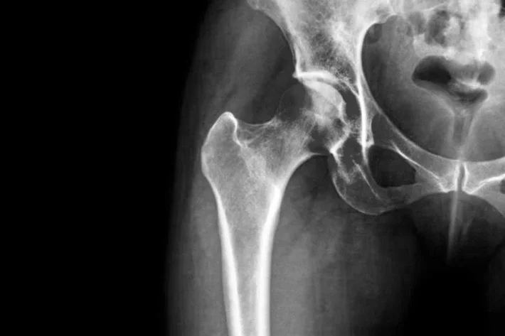Healing From Hip Fractures With Physical Therapy