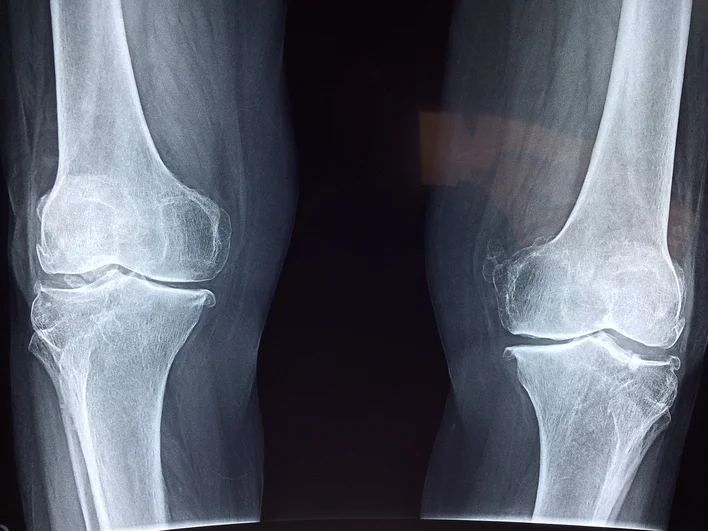How to Live the Good Life with Osteoarthritis