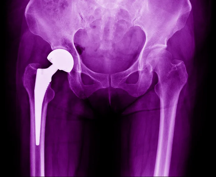 The Hips Don’t Lie—It Could Be Time For a Joint Replacement